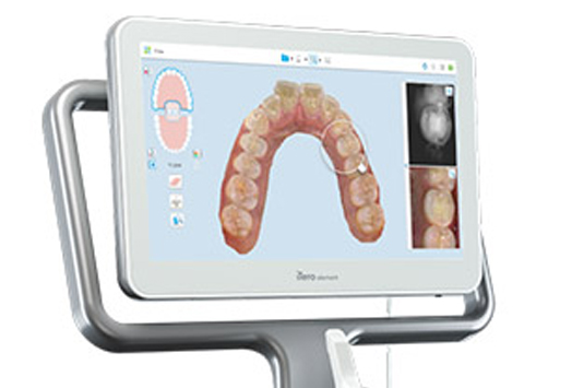 iTero Digital Scanner